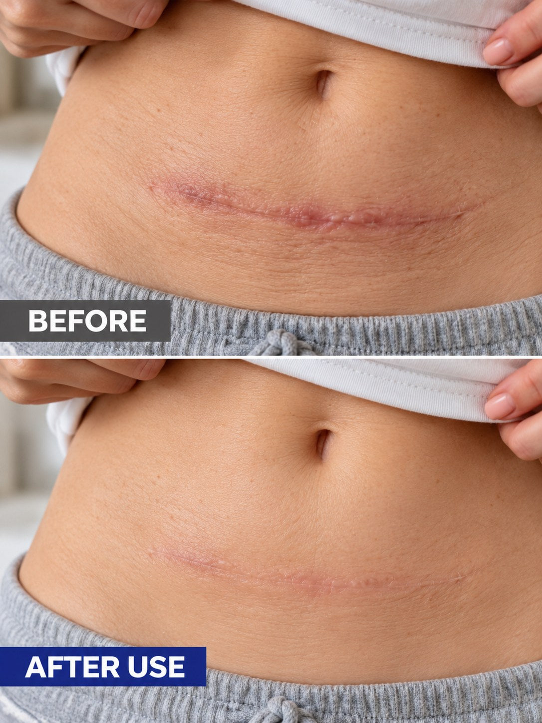 Before and after-use comparison of a fully healed lower-abdomen scar