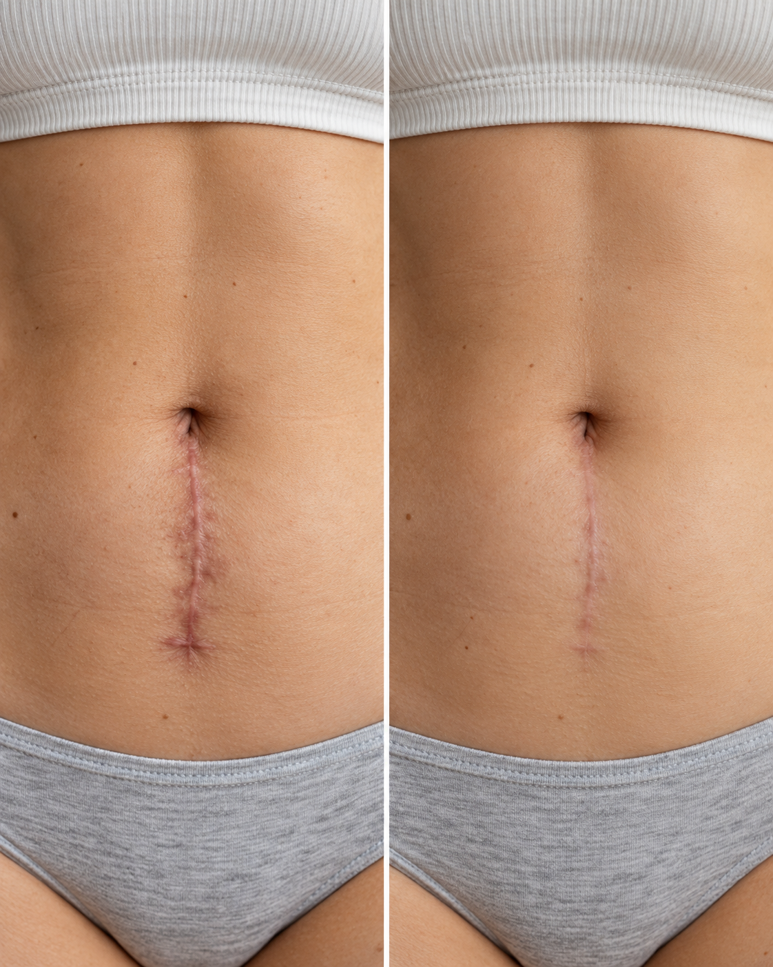 Before and after scar care result 1