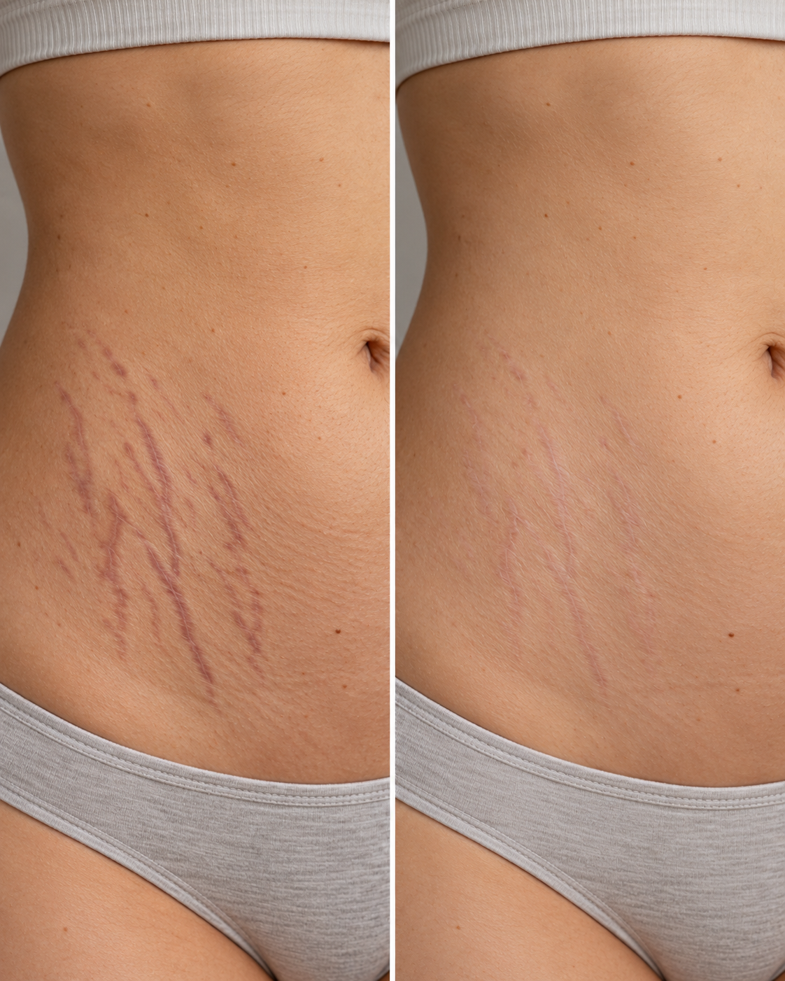 Before and after scar care result 4