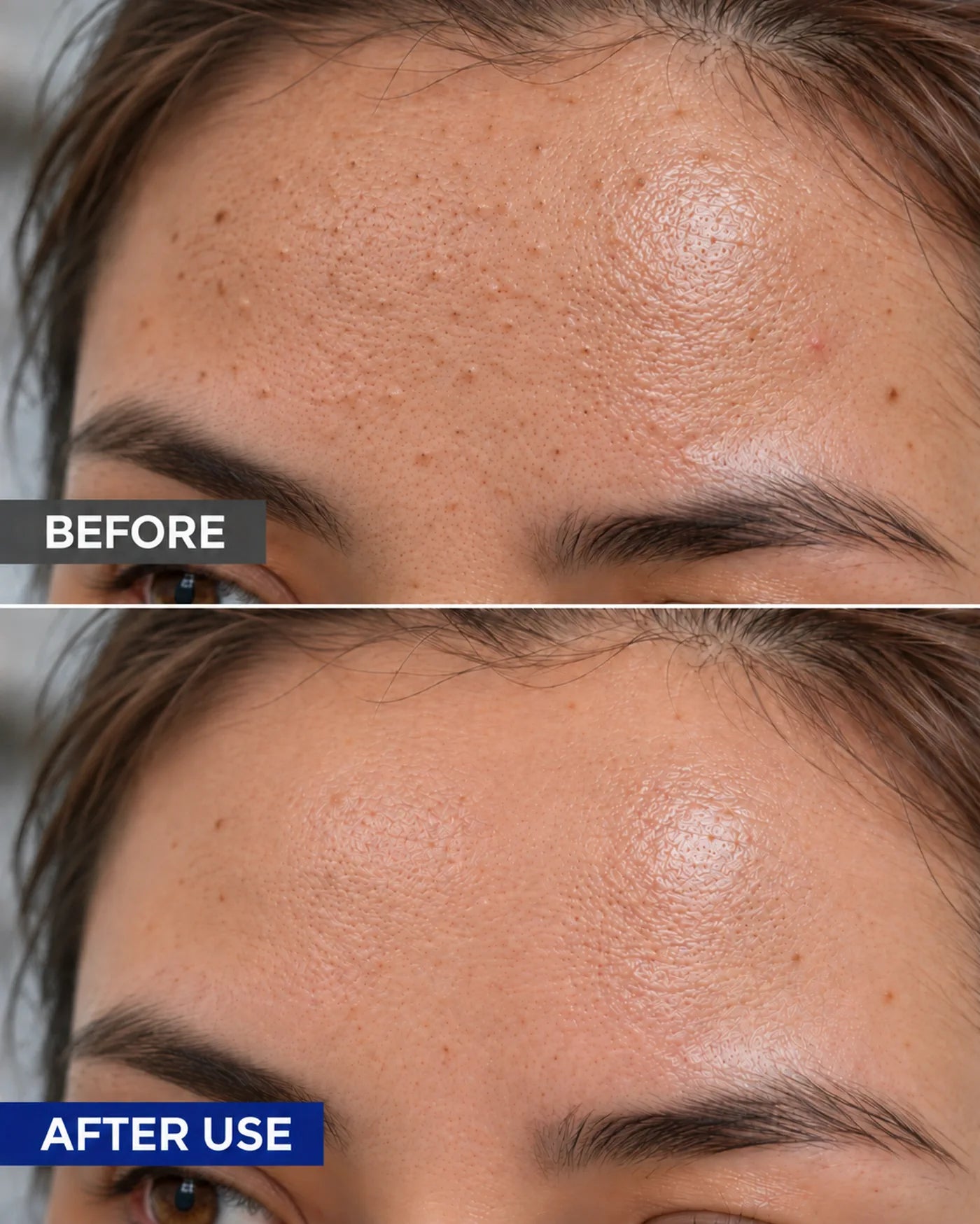 Before and after appearance comparison for forehead pore texture